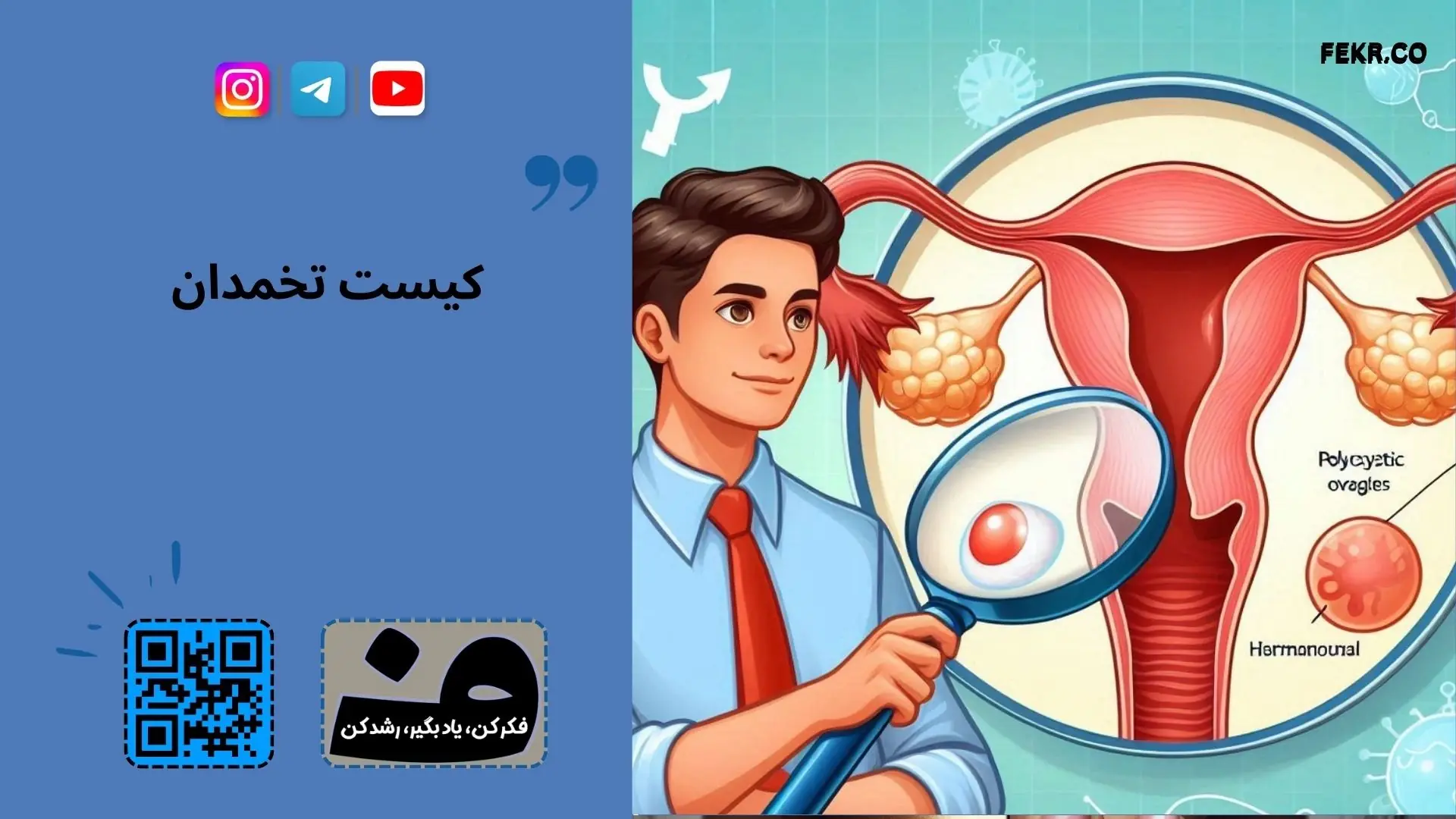 تاثیر سبک زندگی بر روی زنان مبتلا به سندرم تخمدان پلی کیستیک