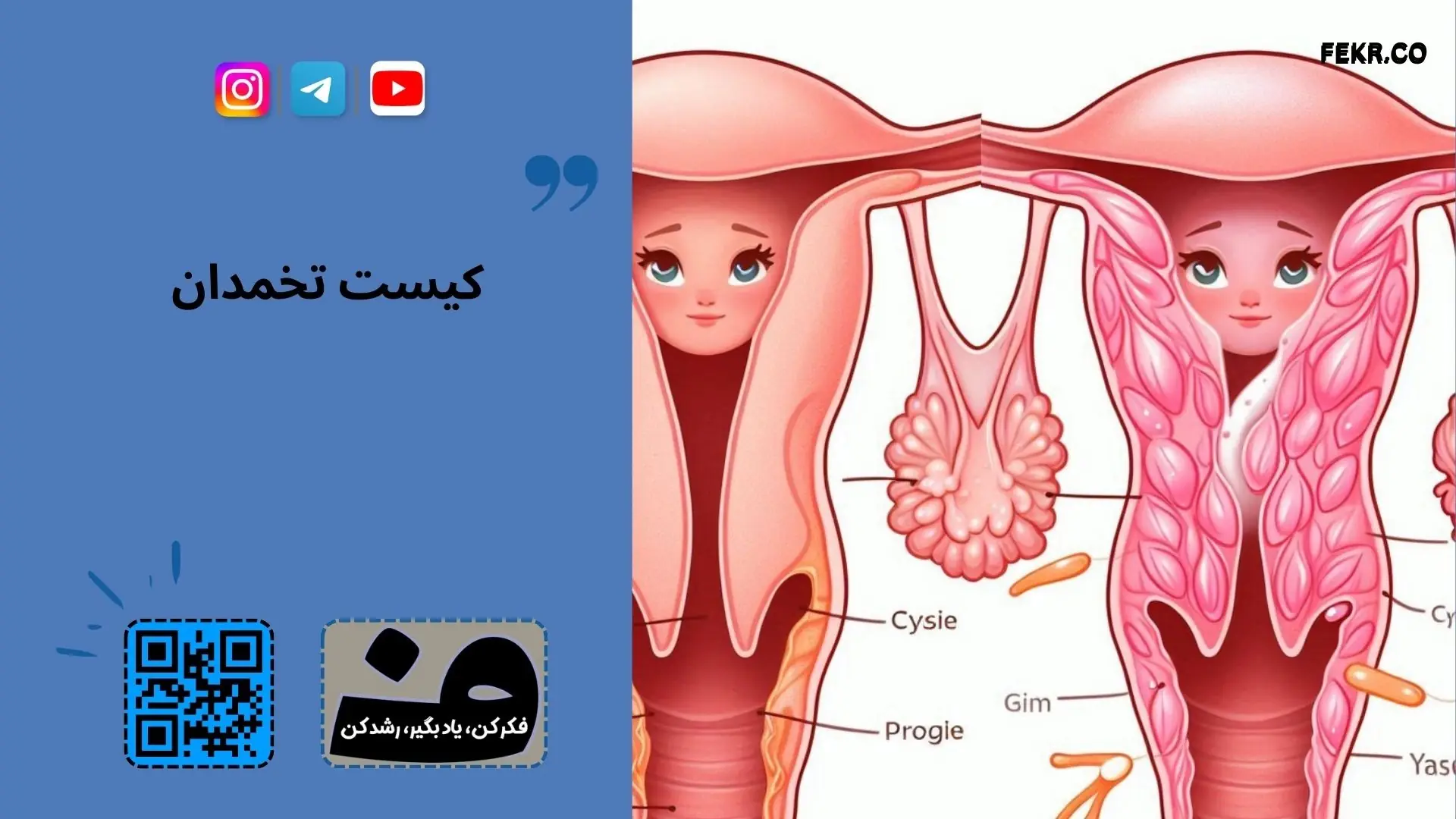 کیست های تخمدان در زنان باردار مشکل ایجاد می کنند؟
