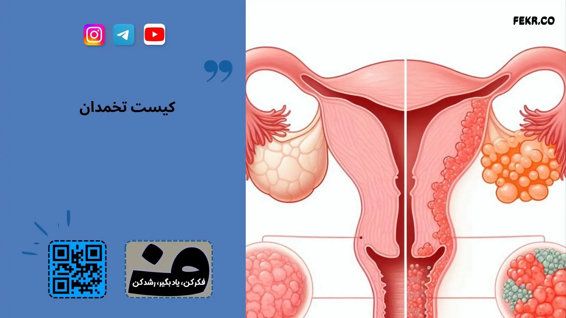 تفاوت تخمدان سالم یا تخمدان پلی کیستیک