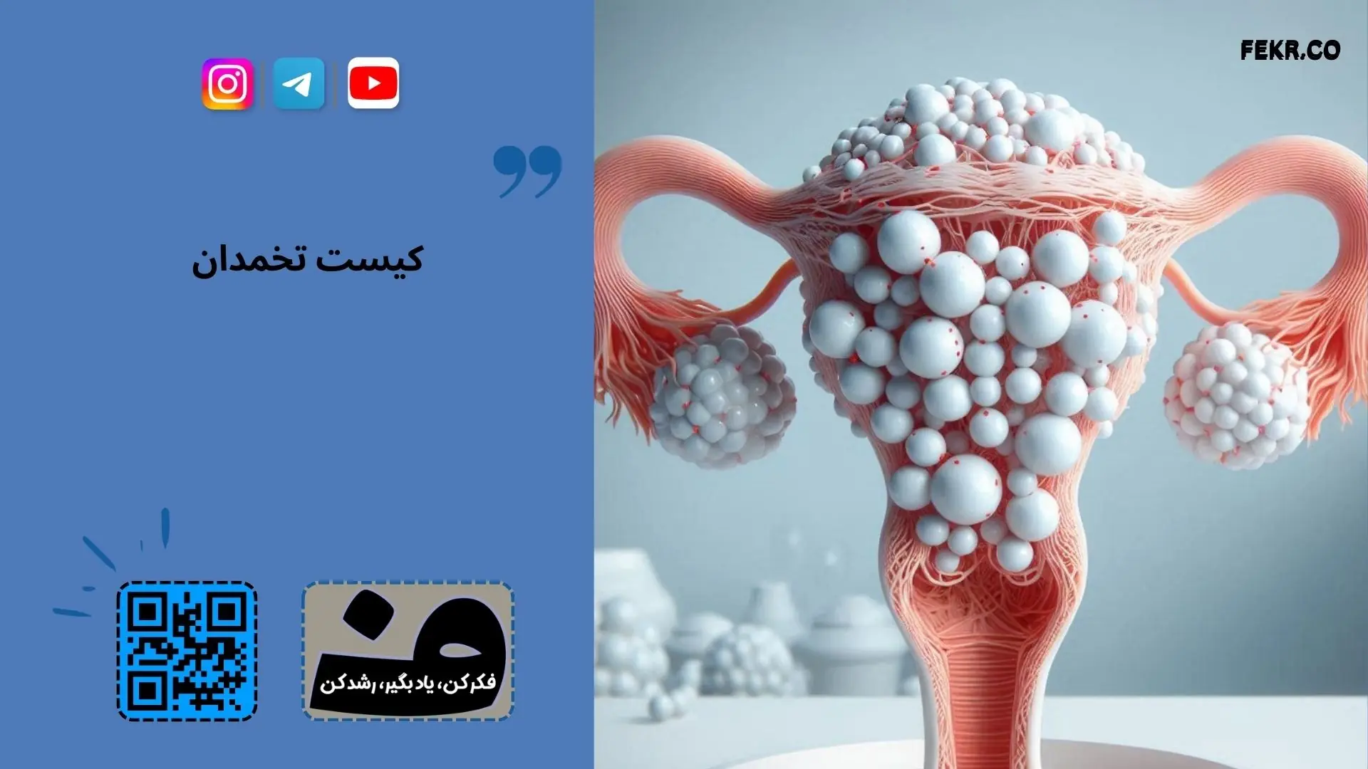 هوس خوردن خوراکی های خاص در سندرم پلی کیستیک