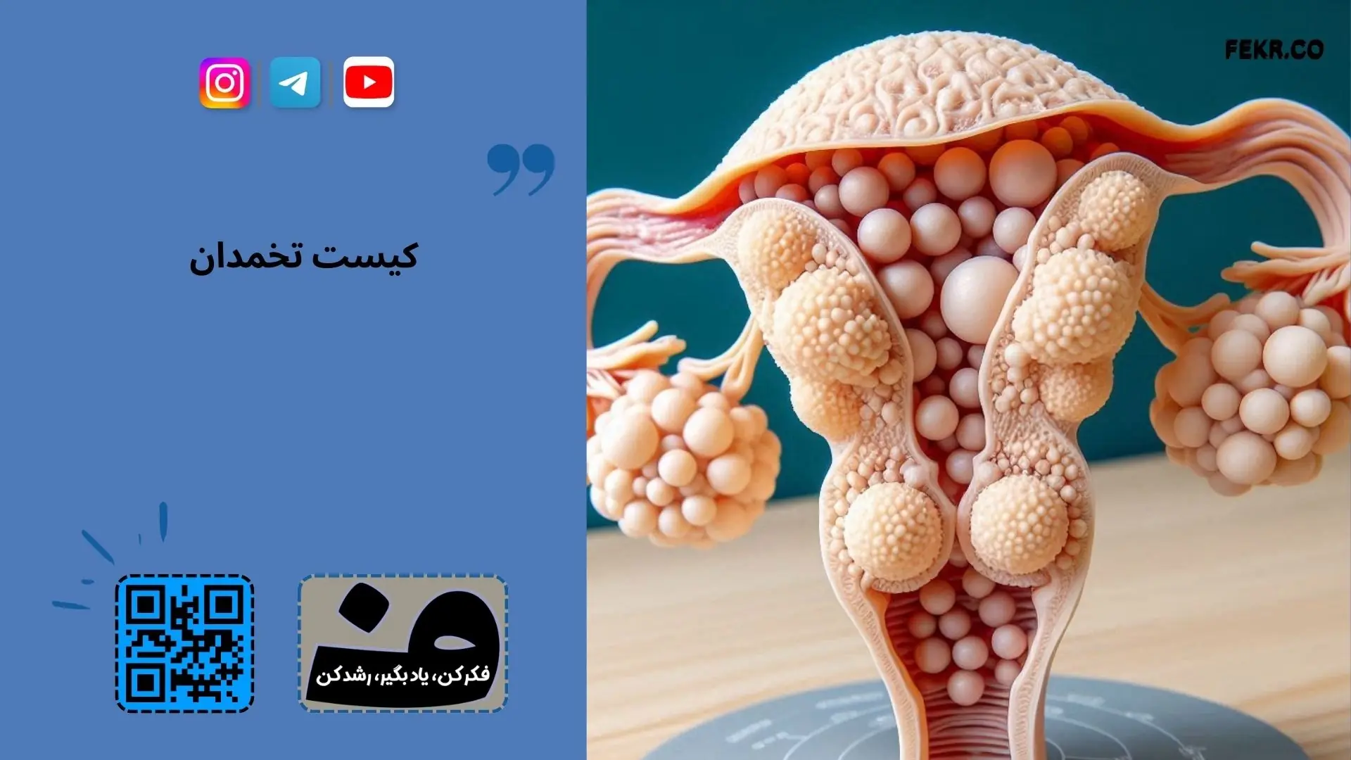 علل بیماری سندرم پلی کیستیک