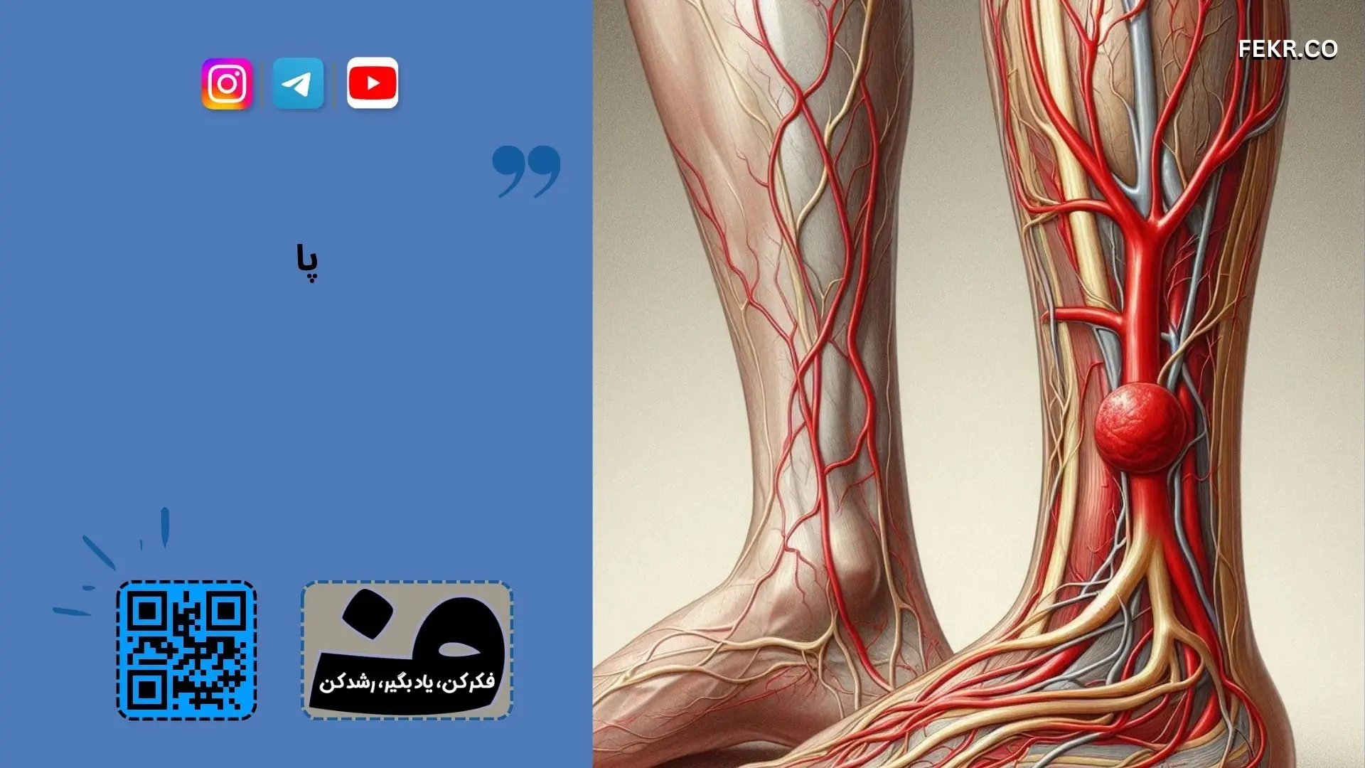 DVT