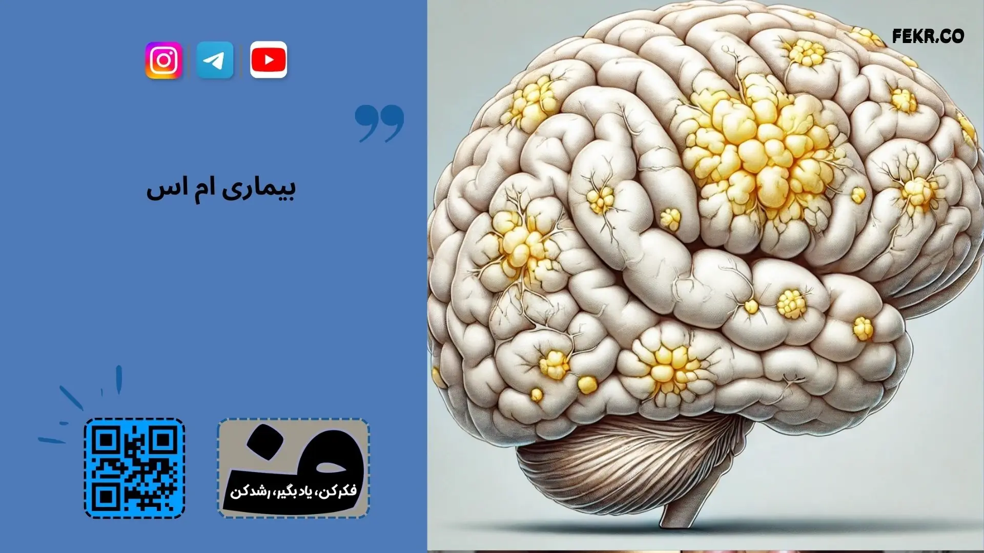 ام اس در میان چه نوع خانواده هایی شایع است؟
